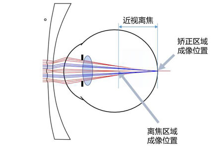 近視離焦眼鏡適合多大孩子？家長必知